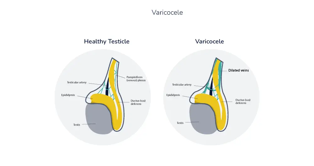 Non-Surgical Testicular Varicocele Treatment Options